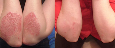 Dolores Fenech Psoriasis Before & After