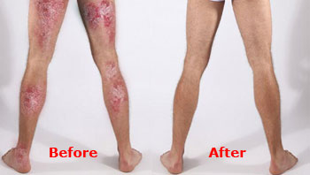 Henry Psoriasis Before & After