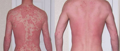 James Thomas Psoriasis Before & After