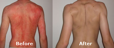 Josephine's Son Psoriasis Before & After