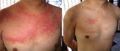 Tony Helson Psoriasis Before & After